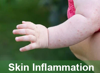 glycyrrhizic acid prevents dermatitis glycyrrhizic acid prevents dermatitis