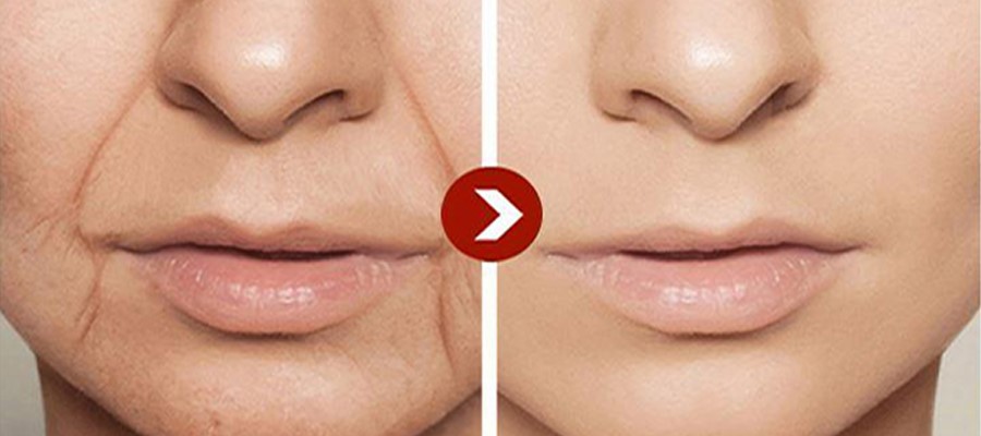 Anti wrinkle Anti wrinkle